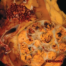 Picture of Carcinoma